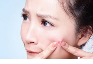 دلایل بروز آکنه