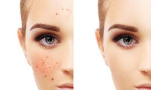 دلایل بروز آکنه