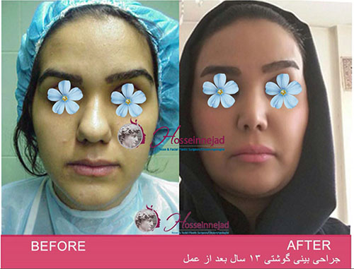 جراحی بینی گوشتی