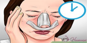 کبودی چشم بعد از جراحی بینی